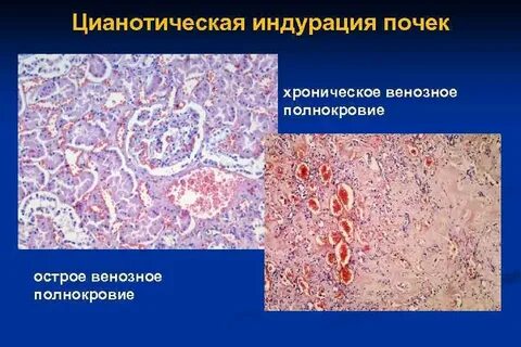 Венозное полнокровие