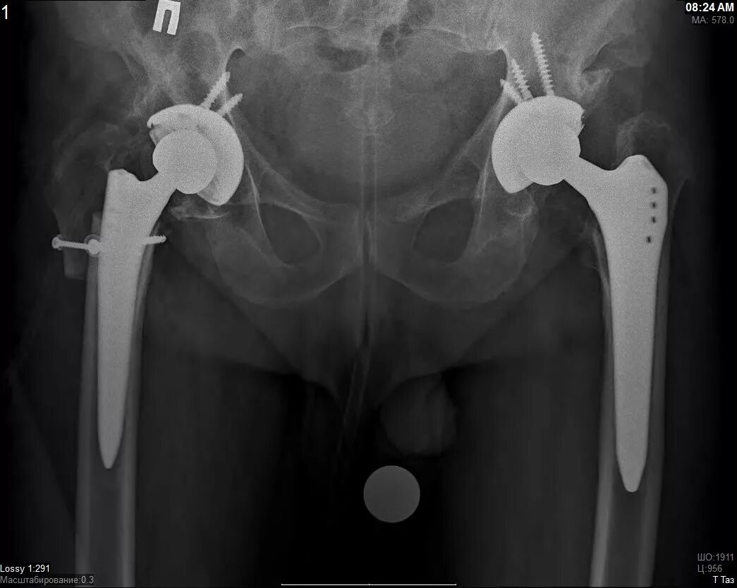 Эндопротезирование тазобедренного сустава Smith nephew. Протез тазобедренного сустава рентген. Эндопротез тазобедренного сустава рентген. Бесцементная фиксация эндопротеза тазобедренного сустава рентген.