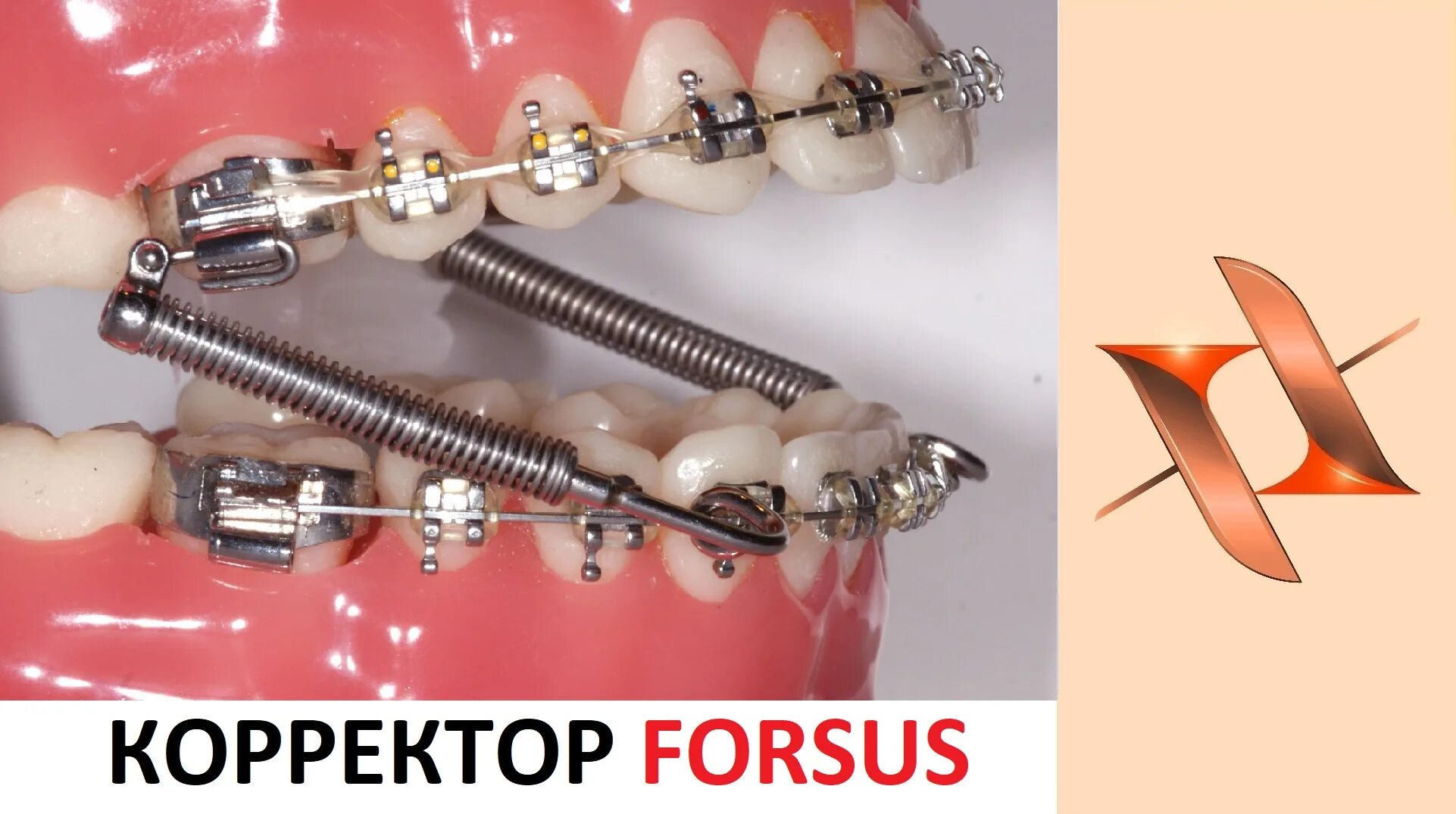 Брекеты с пружиной. Брекеты с пружиной. Аппарат forsus ортодонтия. Твин форс аппарат ортодонтия. Брекеты с пружиной.