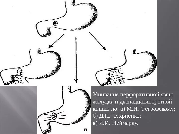 Ушивание язвы желудка и 12-перстной кишки. Ушивание перфорации язвы желудка. Прободная язва желудка опер. Методы ушивания перфоративных язв желудка и ДПК.