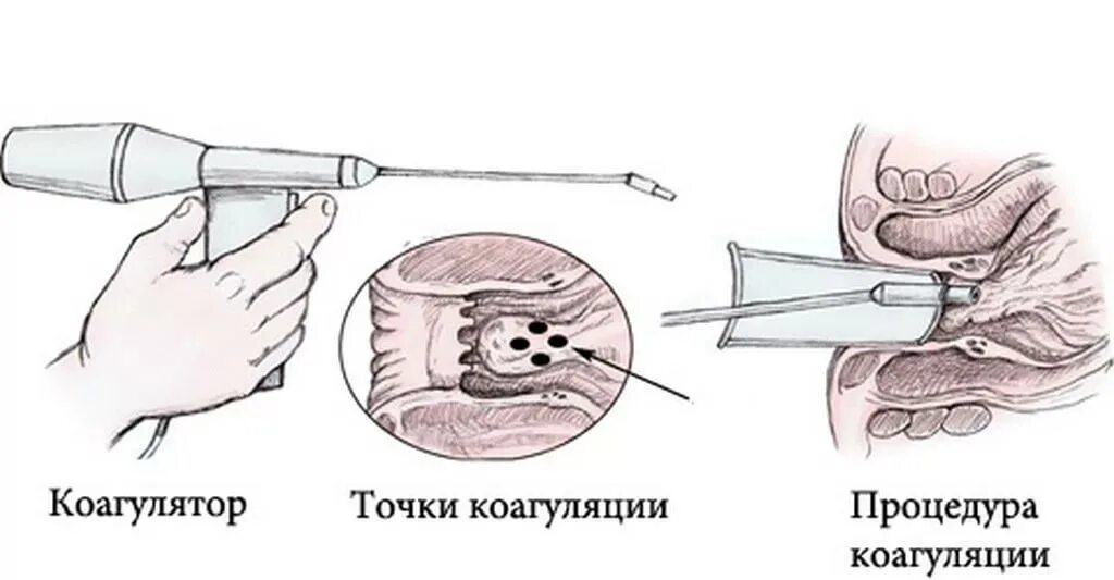 Инфракрасная коагуляция геморроя. Инфракрасная фотокоагуляция геморроидальных узлов. Склеротерапия (склерозирование геморроидальных узлов). Методику инфракрасной фотокоагуляции геморроидальных узлов.. Малоинвазивное лечение геморроя