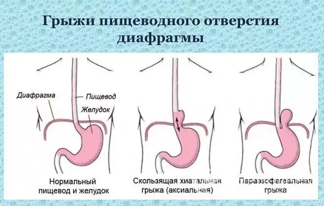Грыжа пищеводного отверстия диафрагмы: симптомы и лечение