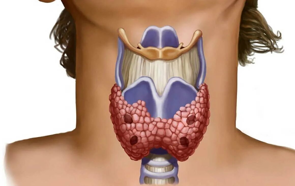 Здоровая щитовидная железа. Воспаленная щитовидная железа.