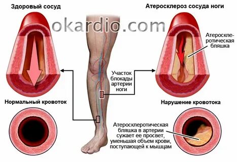 Атеросклероз какой врач