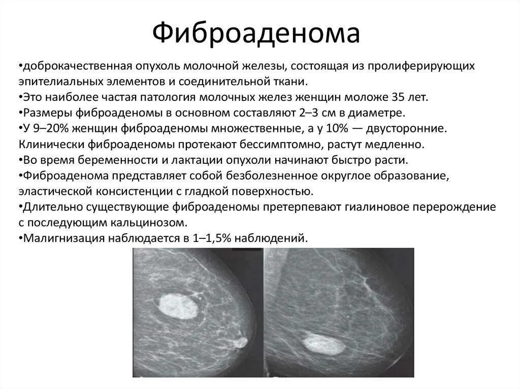 Что означает фиброзное изменение