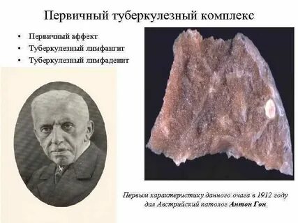Первичный туберкулезный аффект