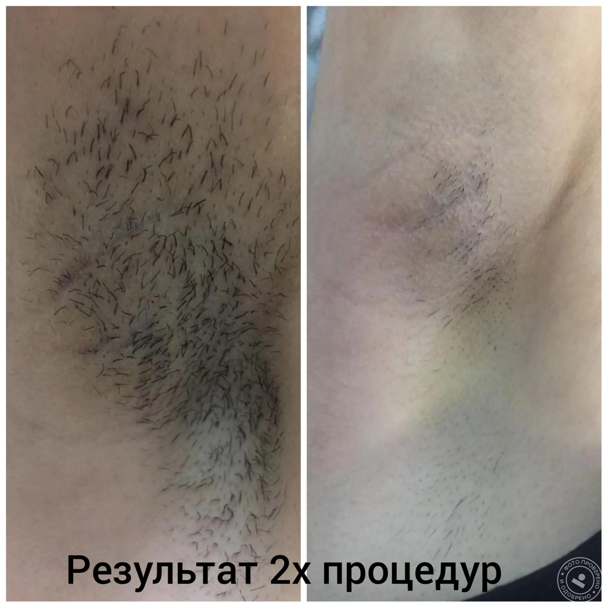 Лазерная эпиляция волосы выпадают через. Лазерная эпиляция бикини и подмышки. электроэпиляция зоны глубокого бикини. лазерная эпиляция глубокое бикини. глубокое бикини после лазерной эпиляции.