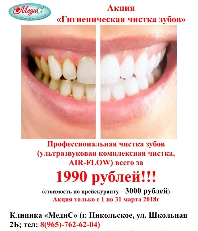 Удалить зуб в ульяновске