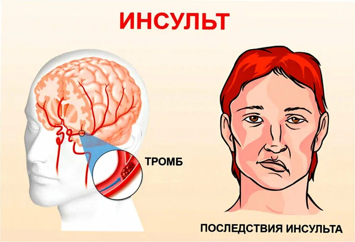 Заболевания ишемического инсульта. Инсульт. Инсульт картинки. Инсульт рисунок.