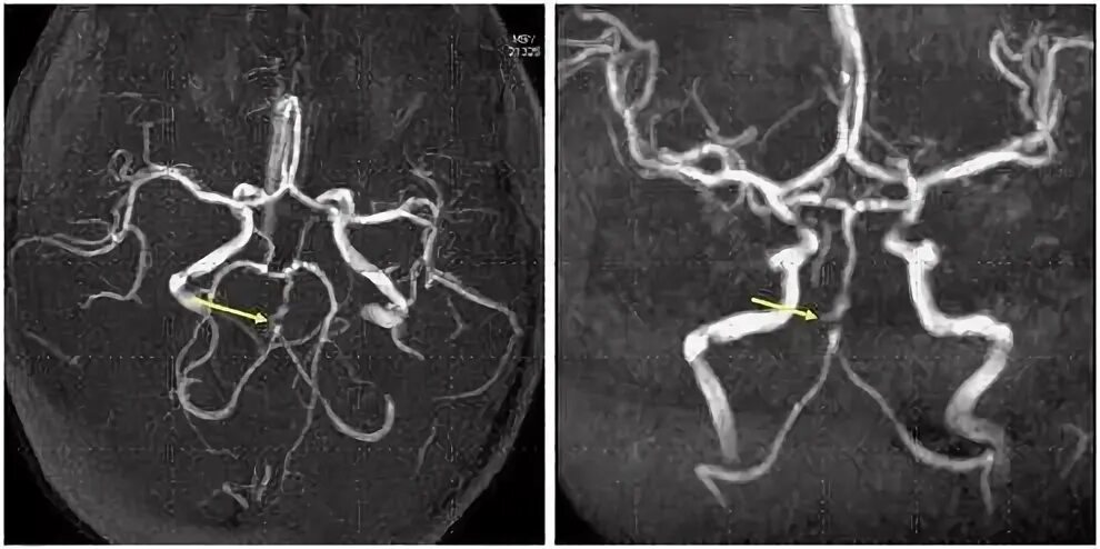 Сегмент а1 пма. Гипоплазия позвоночной артерии кт. Гипоплазия позвоночной артерии мрт. Гипоплазия а1 правой передней мозговой артерии. Гипоплазия сегмента а1 правой ПМА.