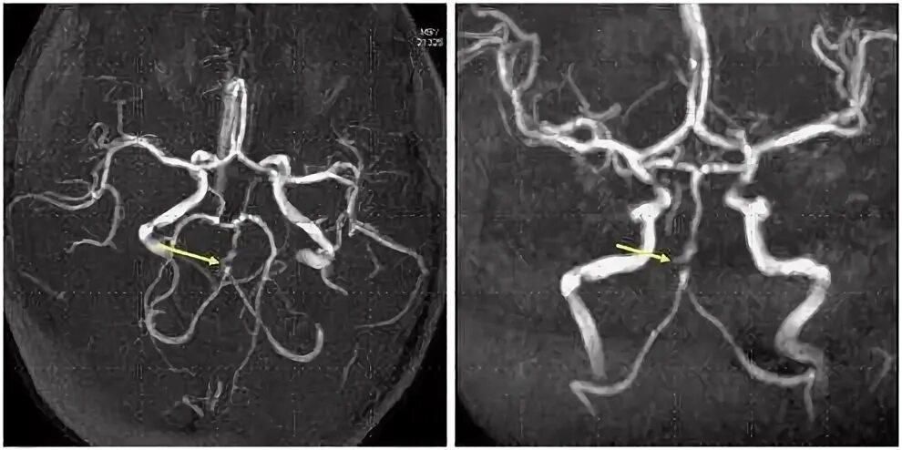 Гипоплазия позвоночной артерии кт. Гипоплазия позвоночной артерии мрт. Гипоплазия а1 правой передней мозговой артерии. Гипоплазия сегмента а1 правой ПМА. Сегмент а1 пма