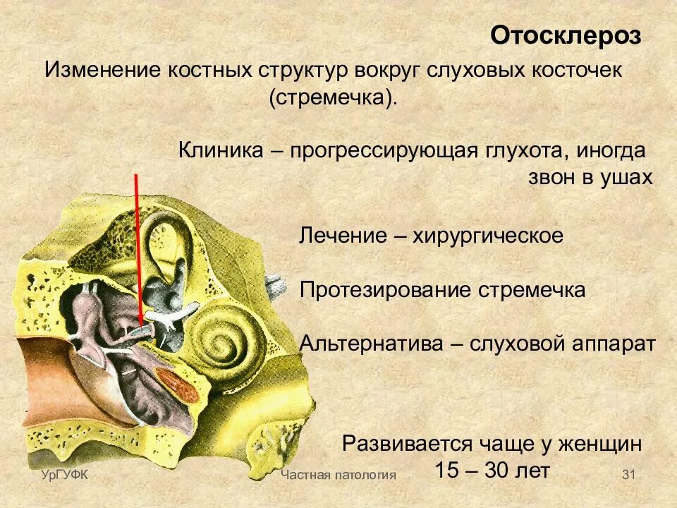 Отосклероз стапедопластика. Слуховой анализатор. Отосклероз уха операция