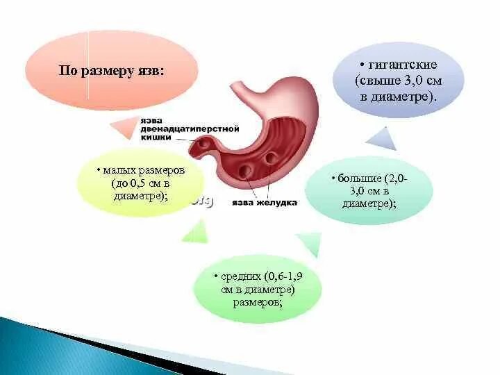 Язвенная болезнь желудка локализация язвы. Язвенная болезнь локализация язв. Размеры язвы желудка классификация. Классификация язв желудка по размеру.