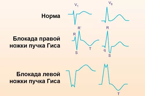 Замедление проведения по правой ножке пучка. Блокада ножек пучка гиса на экг. нарушение проводимости пучка гиса на экг. блокада правой ножек пучка гиса на экг. неполная блокада левой ножки пучка гиса на экг.