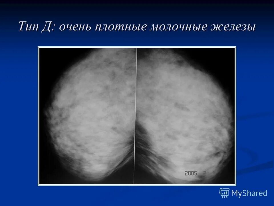 молочная железа тип d. тип строения молочных желез по acr. мастопатия молочной железы маммограмма. тип d структуры молочных желез. плотность молочной железы классификация.