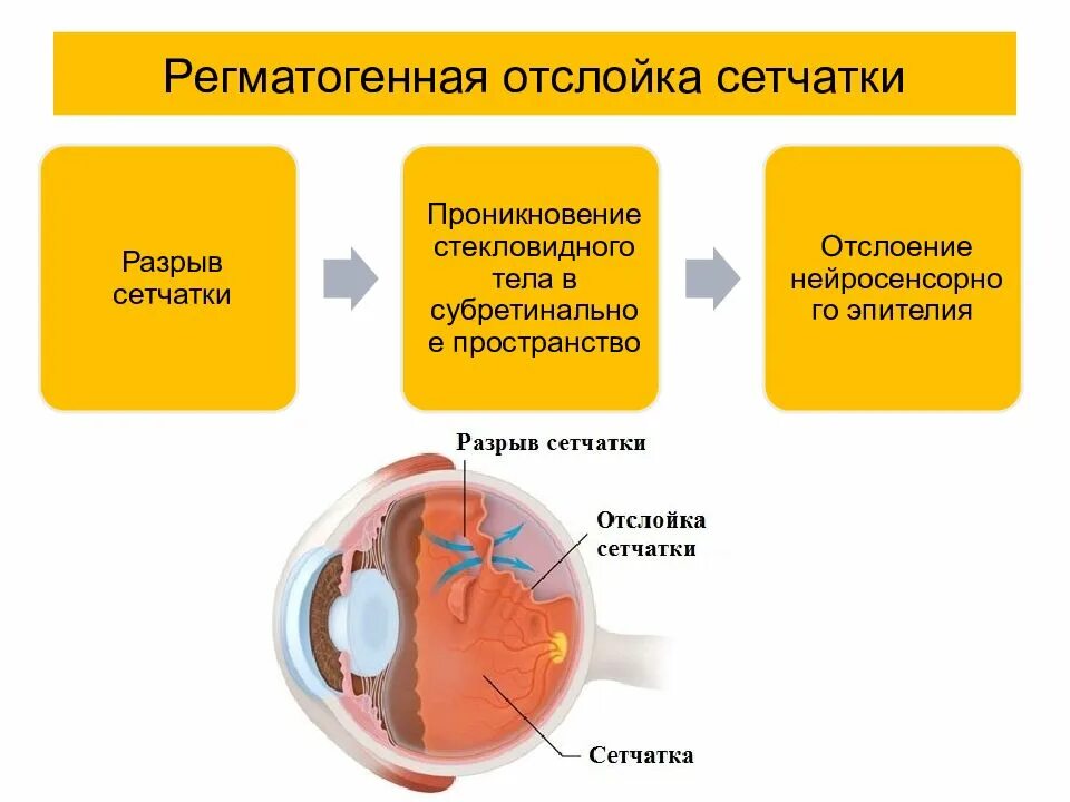 Дифференциальный диагноз отслойки сетчатки. Этиология отслойки сетчатки глаза. Диф диагноз первичной и вторичной отслойки сетчатки. Патогенез отслоения сетчатки.