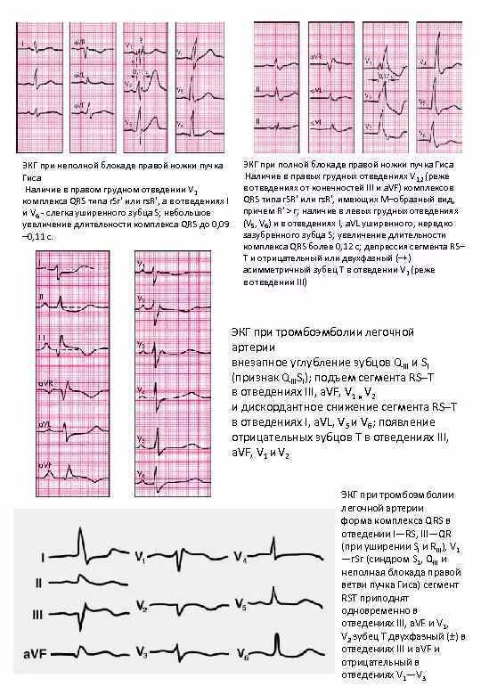 Блокада qrs. Блокада ПНПГ на ЭКГ. Неполная блокада ПНПГ на ЭКГ. ЭКГ при неполной блокаде правой ножки пучка Гиса. ЭКГ при неполных блокадах ножек пучка Гиса.