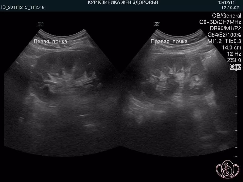 УЗИ почек острый пиелонефрит. УЗИ почек пиелонефрит гломерулонефрит. Острый пиелонефрит УЗИ картина. Что такое ЧЛС почек на УЗИ. На узи видно воспаление