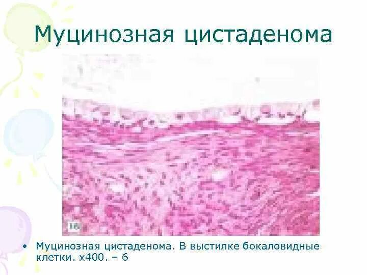 Гистология цистаденомы. Цистаденома яичника микропрепарат цитологический. муцинозная цистаденома яичника микропрепарат. муцинозная цистаденома яичника гистология. муцинозная киста яичника гистология.