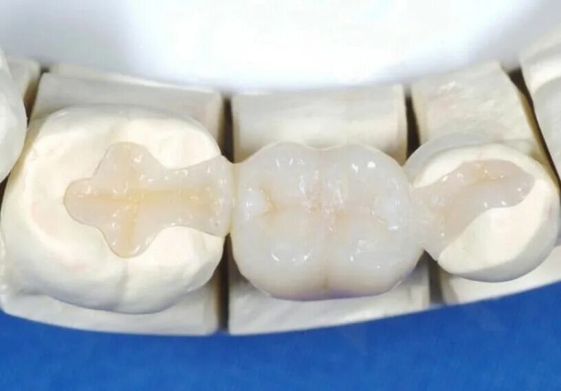 Мэриленд адгезивный мостовидный протез. Мэриленд мостовидные протезы. Адгезивный мостовидный протез на 2 зуба. Штамповано-паяный мостовидный протез. Мэриленд адгезивный мостовидный протез.