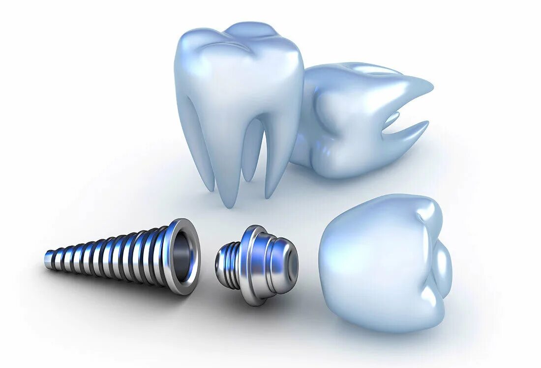 Альфа био импланты. Имплантаты Medent. Имплантация зубов Dental implan. Имплант зуба абатемнет.