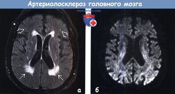 Субатрофические изменения мозга. Артериолосклероз головного мозга на кт. Гипоинтенсивный очаг мрт. Мрт шапка. Гиперинтенсивными при мрт.