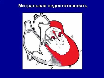 Ада ткин врожденная недостаточность