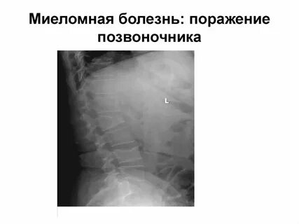 Миеломная болезнь что это за болезнь