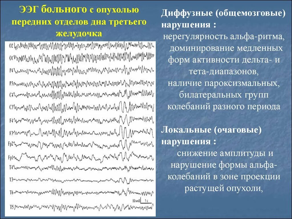 Дельта активность на ЭЭГ У взрослых. Энцефалограмма головного мозга. Биоэлектрическая активность головного мозга. Ритмы ЭЭГ.. Региональная эпилептиформная активность ЭЭГ.