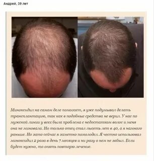 Как правильно пользоваться миноксидилом