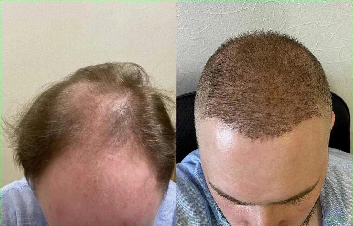 Клиники пересадка волос цены. Роб Холдинг пересадка волос. Волосы после пересадки волос. Месяц после пересадки волос.
