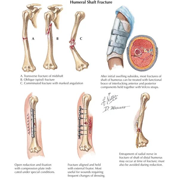 The fracture can be. Mid shaft spiral fracture humerus.