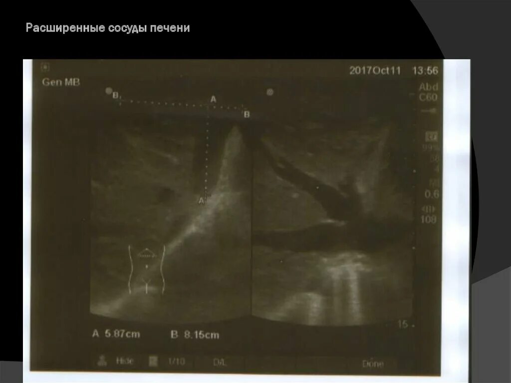 Расширение сосудов печени. Расширение печеночных вен на УЗИ. Сосуды в печени увеличены. Печень расширены вены