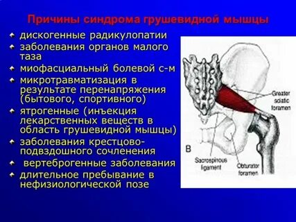 Седалищная болезнь