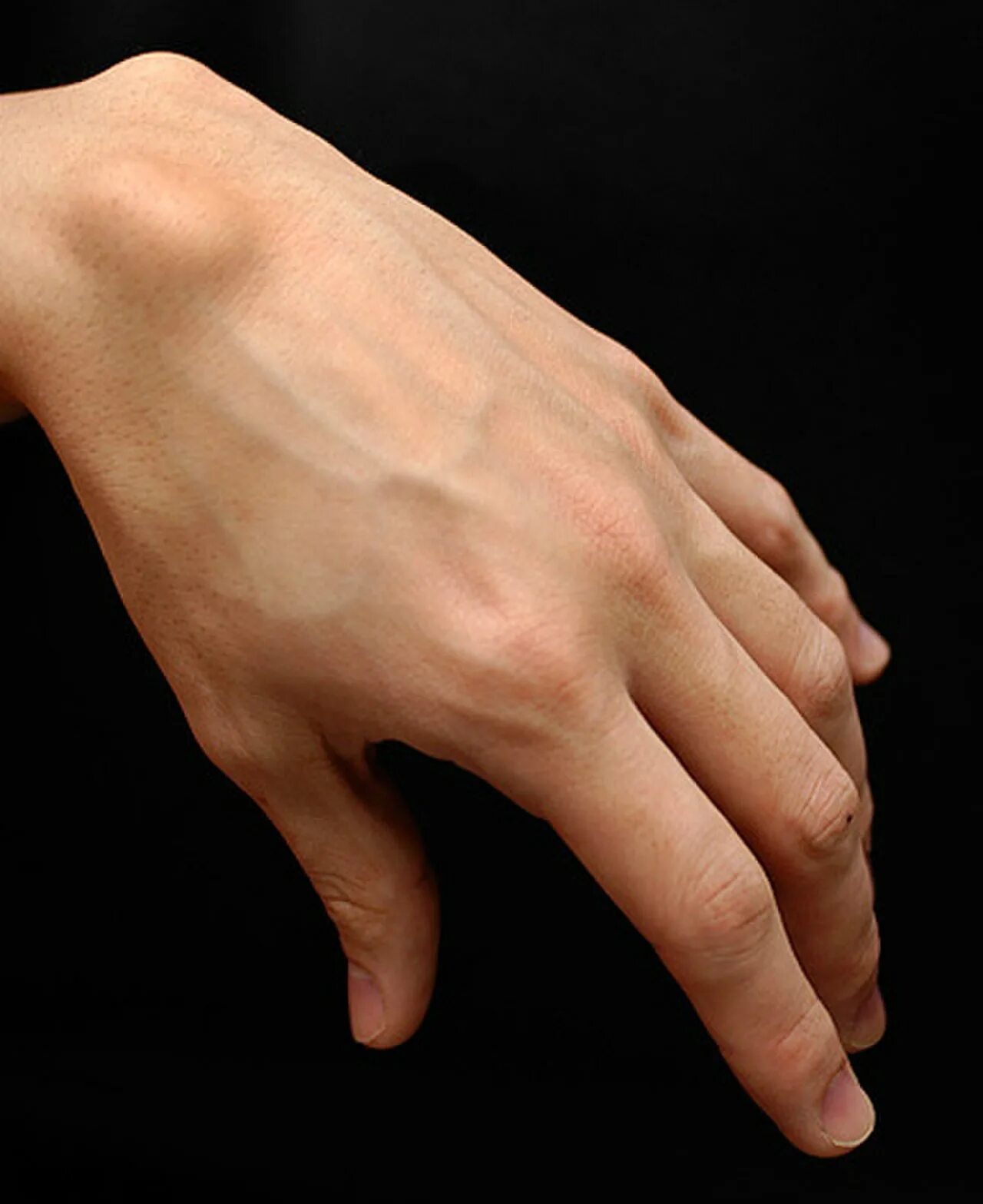 Рука буда. Гигрома сустава Лисфранка. Ганглион лучезапястного сустава.