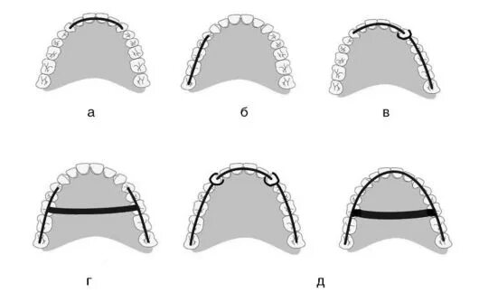 Стабилизация зубного ряда. Парасагиттальная стабилизация зубного ряда это. Схема наклона оси управляемого колеса. Весовая стабилизация автомобиля. Стабилизация управляемых колес весовая скоростная упругая.