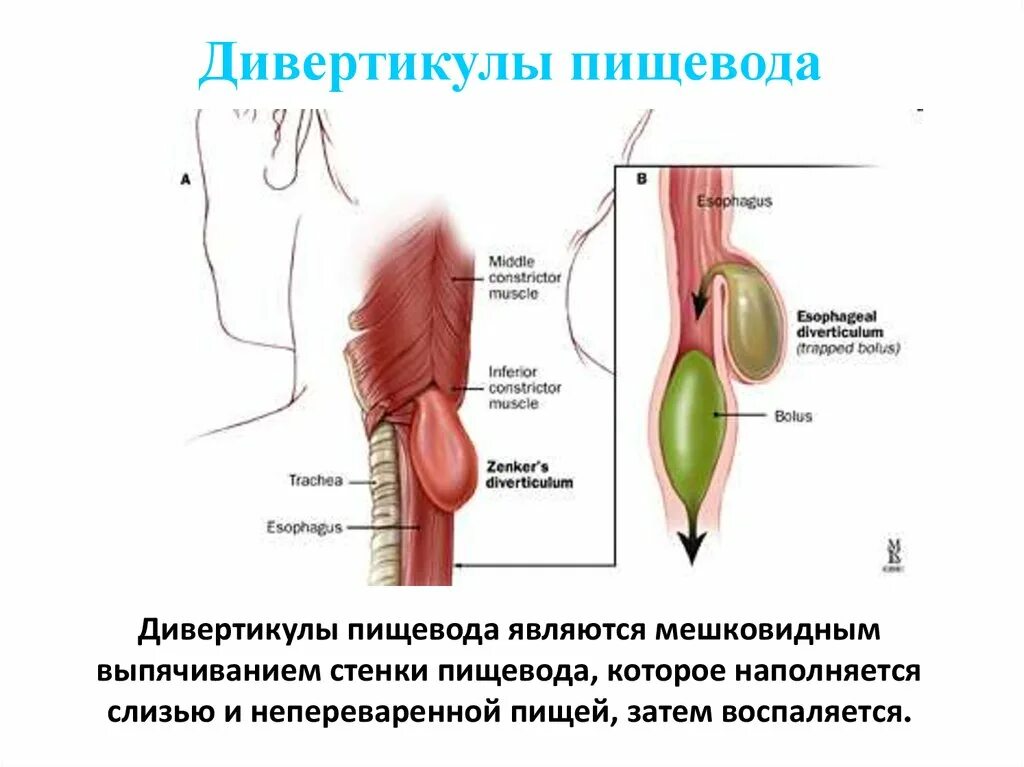 Став пищевода. Дивертикул Ценкера пищевода. Наддиафрагмальный дивертикул пищевода. Эпифренальные дивертикулы пищевода. Бифуркационный дивертикул пищевода.