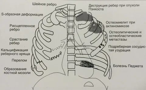 Аномалии развития ребер и грудины