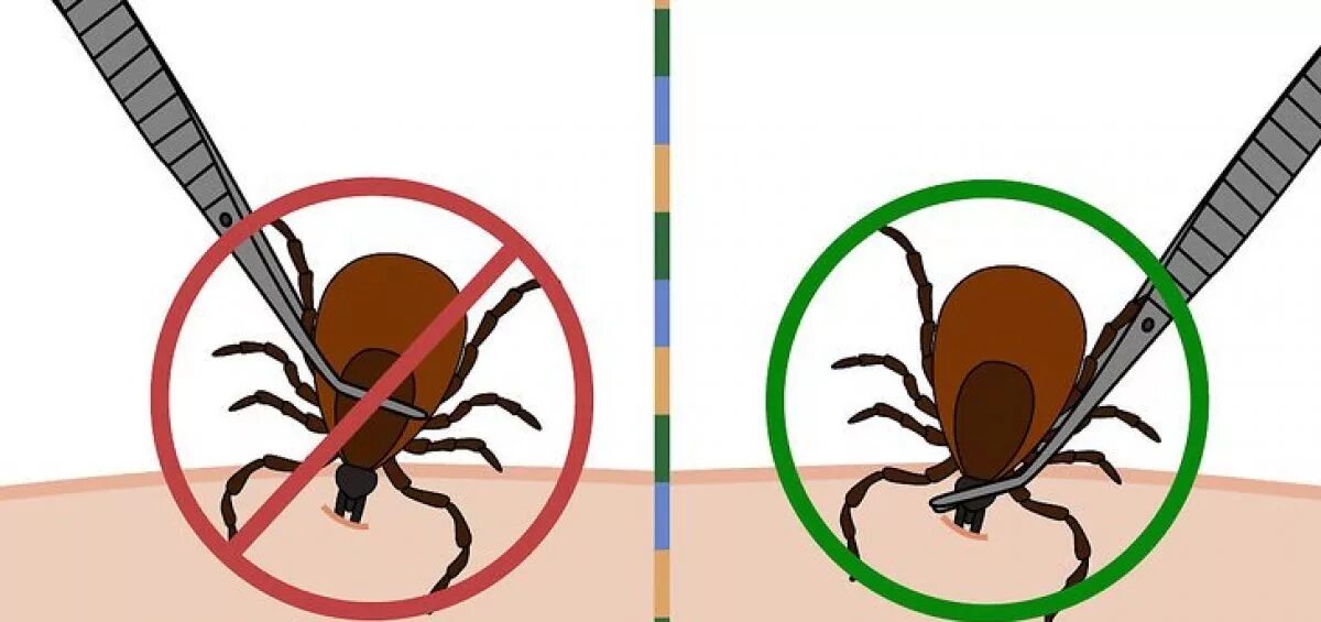 Как удалить клеща у человека самостоятельно присосавшегося