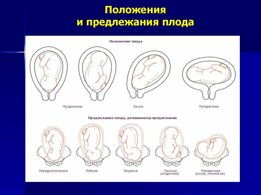 Положение предлежание. Позиции предлежания плода. Позиции плода в матке. Виды предлежания плода. Заднее предлежание плода