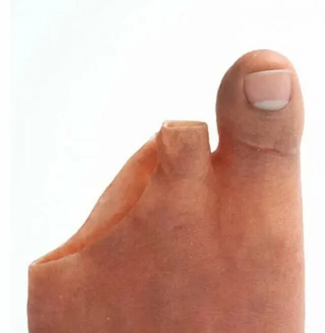 Как выглядит нога без пальца Broken toe showing bruising on skin due to injury Фотографія Stock Adobe Stock