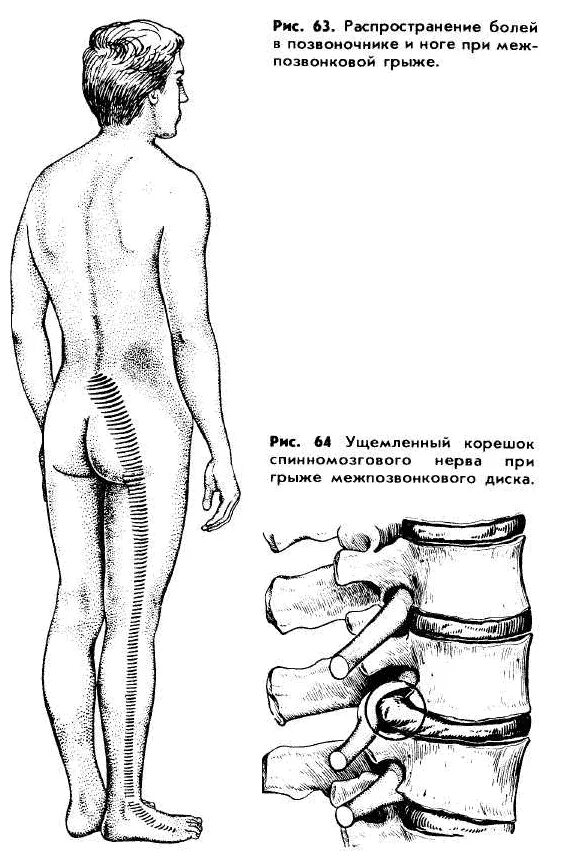 Болит нога от позвоночника. Грыжи позвоночника в поясничном отделе схема. Боли при грыже поясничного отдела позвоночника. Иррадиация боли при грыже поясничного отдела.