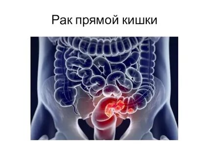 Рак прямой кишки с метастазами