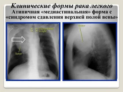 Синдром полой
