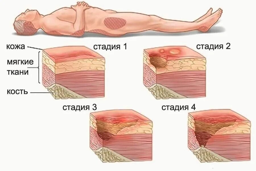 Стадия тканей