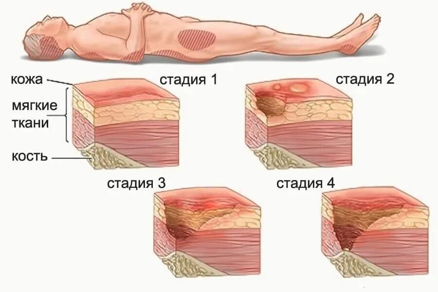 Уход за язвами. 2 Стадия пролежней на человеке.