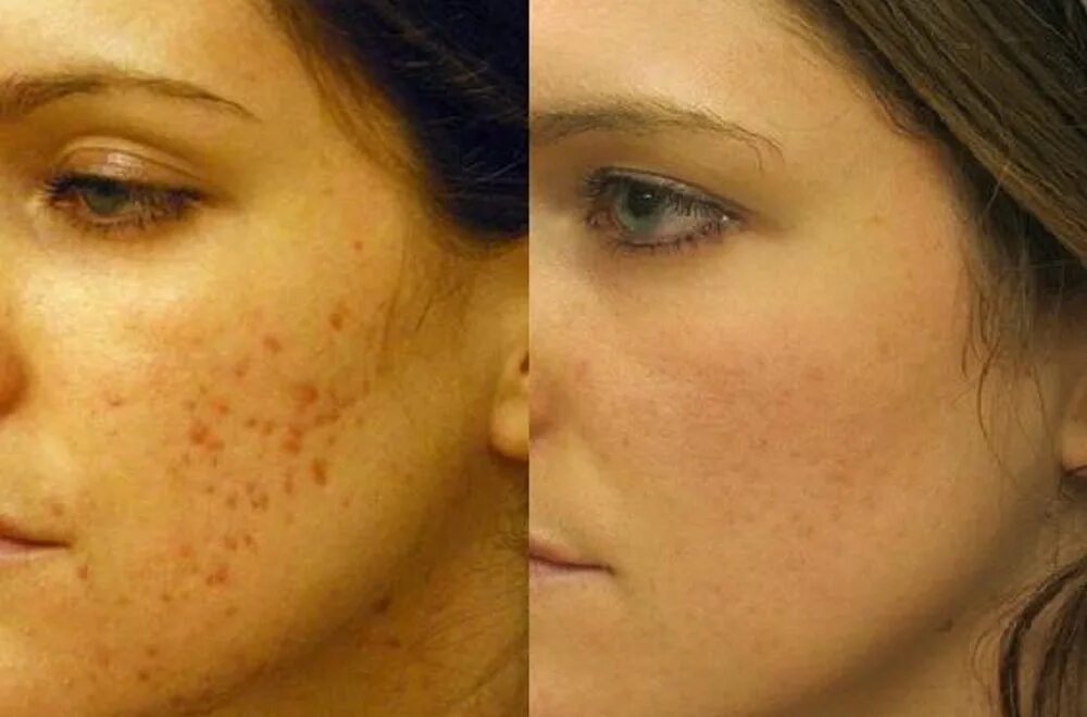 Плазмолифтинг при акне. Проблемная кожа до и после. Акне постакне холодная плазма. Алмазная шлифовка постакне. Лицо после угревой.