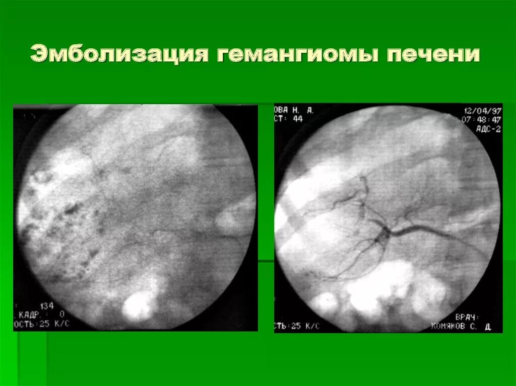 При гемангиоме печени можно ли. Эмболизация гемангиомы. Эмболизация сосудов гемангиомы. Эндоваскулярная эмболизация гемангиомы печени.