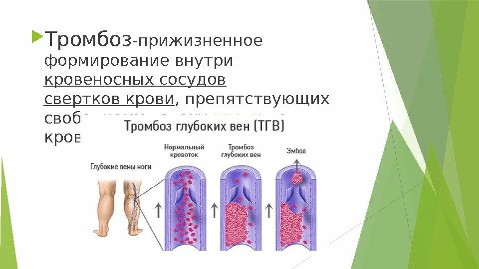 Тромбоз кровеносных сосудов. Чем отличается тромб