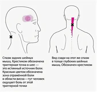 Головная боль от спазма